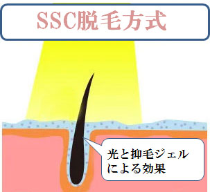 SSC（スムース・スキン・コントロール）脱毛